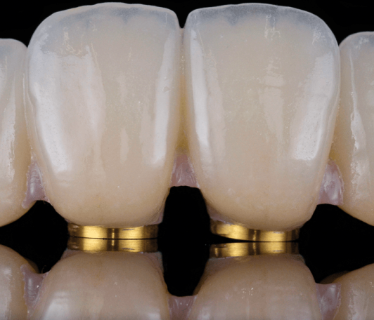 Korony cyrkonowe vs. Korony ceramiczne: odkrywanie różnic w stomatologii-zdjęcie